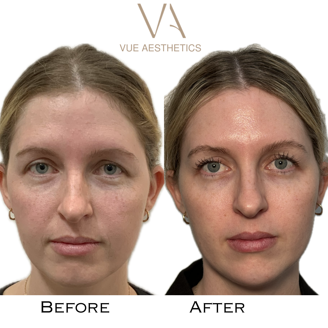 Blog | VUE AESTHETICS- Cosmetic Consultations for non-surgical skin &  facial treatments